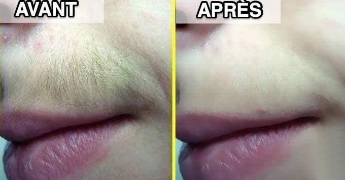 Épilation Moustache : 3 Astuces de Grand-mère Qui Marchent Pour Se Débarrasser du Duvet.