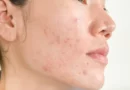 10 problèmes de peau courants et comment les traiter : Infections cutanées