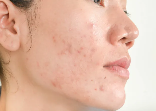 10 problèmes de peau courants et comment les traiter : Infections cutanées