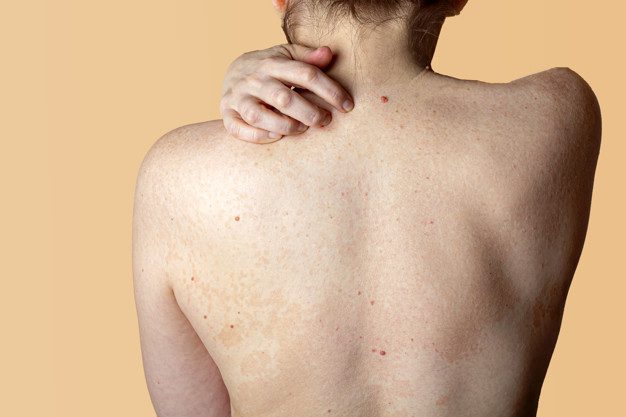 Les meilleurs conseils et traitements pour l’acné du dos