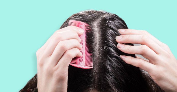 how to get rid of dry scalp and dandruff