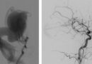#Première #mondiale à l’Hôpital Universitaire de Bruxelles dans le traitement des #malformations vasculaires cérébrales chez les #nouveaux-nés