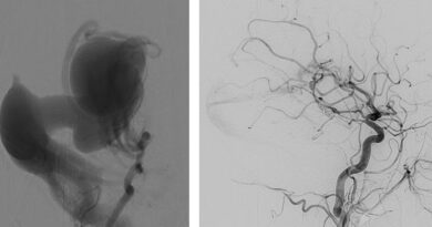 #Première #mondiale à l’Hôpital Universitaire de Bruxelles dans le traitement des #malformations vasculaires cérébrales chez les #nouveaux-nés