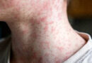 Le #virus de la #rougeole est de retour et #Schaerbeek réagit