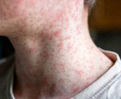 Le #virus de la #rougeole est de retour et #Schaerbeek réagit