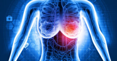 Santé : De nouveaux progrès dans le traitement du cancer du sein