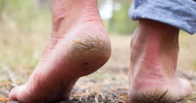 Talons secs Astuce simple avec de lamidon de mais pour des pieds doux